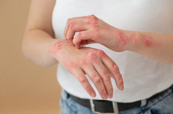 What Is Psoriatic Itching How To Deal With It