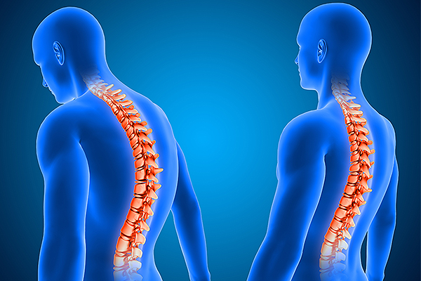 Killing the Symptoms Of Cervical Spondylosis With Herbal Remedies