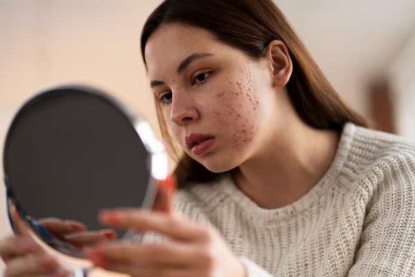 How to Use Ayurvedic Toners and Cleansers for Acne-Prone Skin